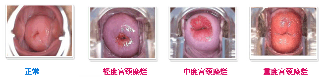 宫颈糜烂影响怀孕吗?
