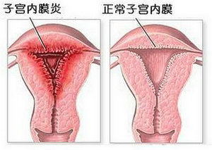 子宫内膜炎.jpg