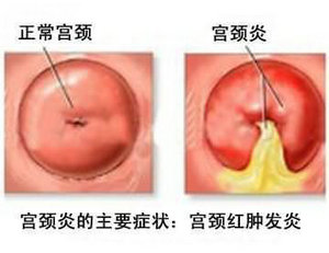宫颈炎.jpg