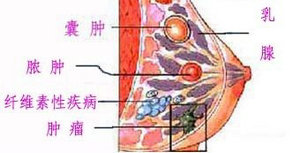 乳腺囊肿.jpg